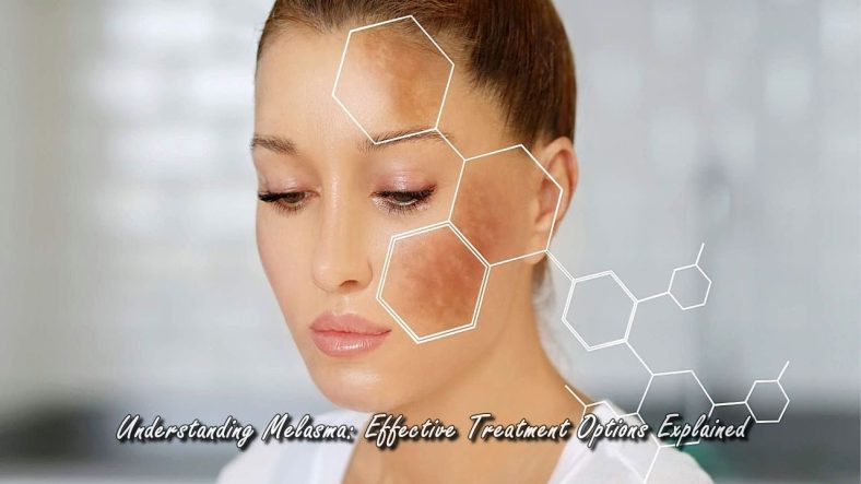 Understanding Melasma: Effective Treatment Options Explained